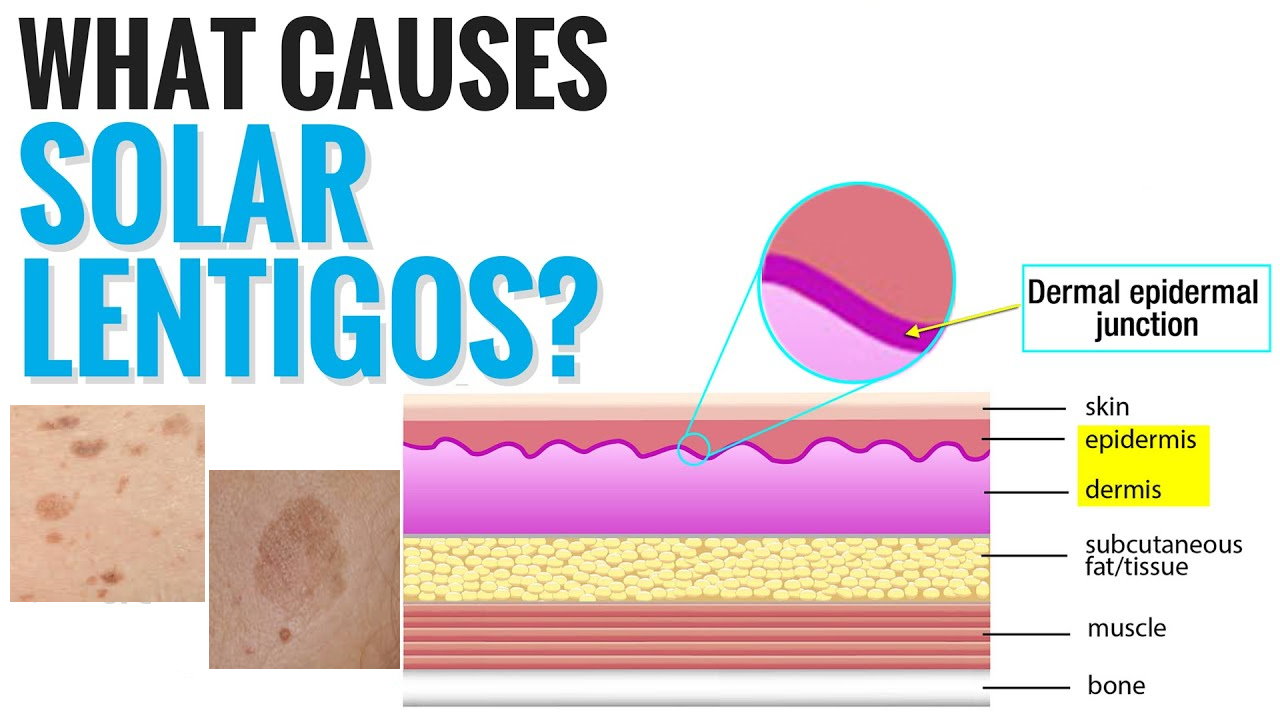 孚立美“氟轻松氢醌维A酸乳膏”能用于老年斑治疗吗？